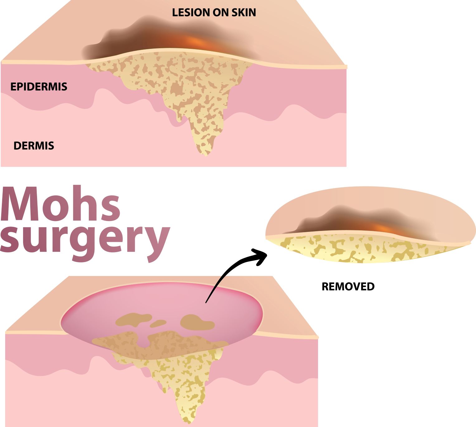 Mohs Surgery Infographic