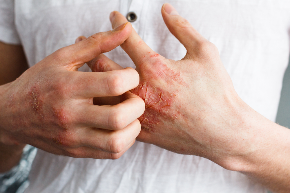 Eczema on mans hands
