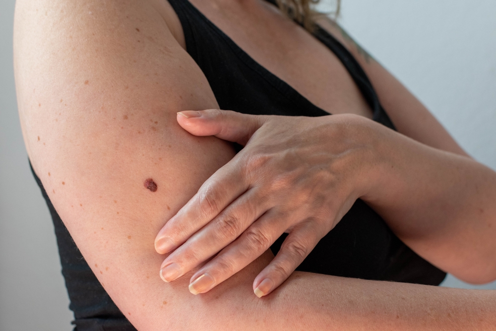 woman checking skin for skin cancer.