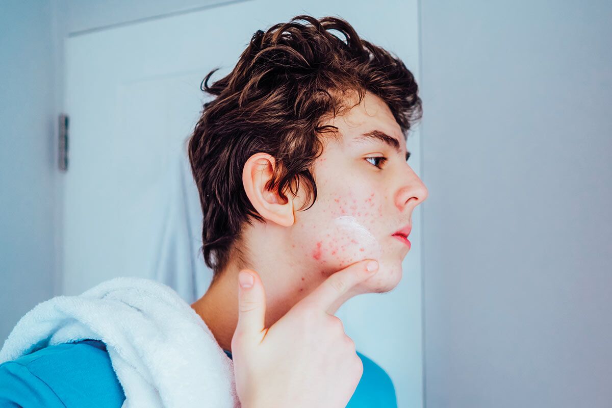 Teenage boy rubbing cream on acne on his face